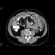 Carcinosis of mesentery: CT - Computed tomography